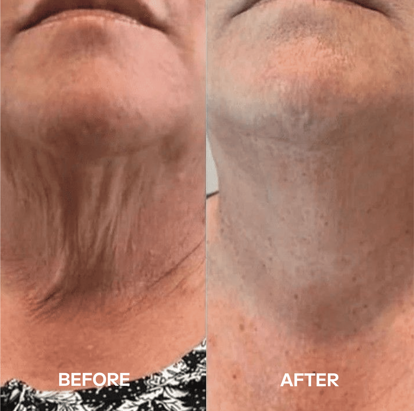 Dealing With Wrinkles, Sagging Skin, or Lines on Your Neck? Get a Visibly Younger-Looking Neck  in Just 3 Hours